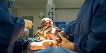 Vidas de milhões de bebês podem mudar com simples teste do cordão umbilical; entenda