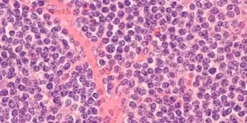 O quebra-cabeça de um câncer raro e agressivo