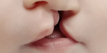 SUS passa a ofertar cirurgia e fonoaudiologia para pacientes com lábio leporino