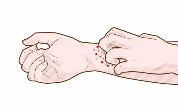 Dermatite atópica: SUS passa a oferecer tratamento integral para a doença