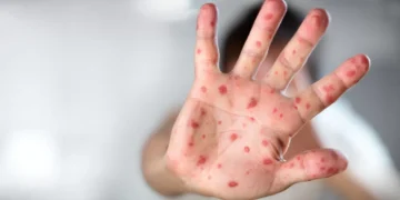 Entenda o que é a “dose zero” contra o sarampo, anunciada para bebês
