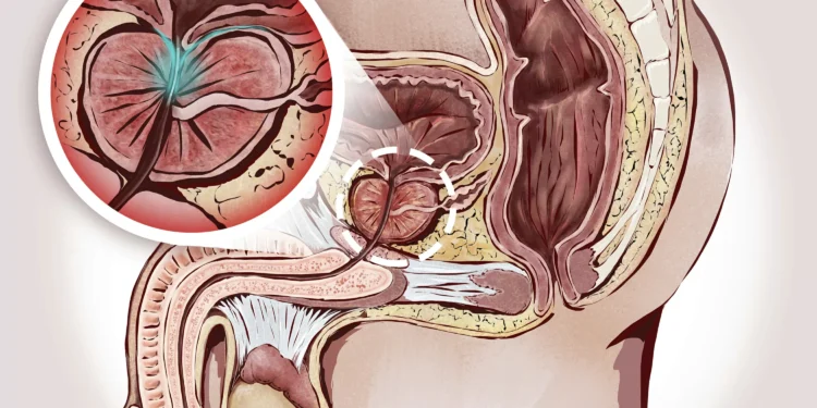 Câncer de próstata: diagnóstico de personalidades é um convite ao cuidado