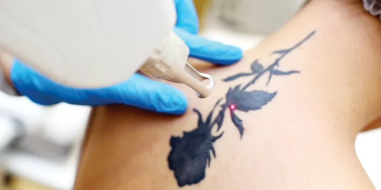 Nada é para sempre: cresce o movimento de remoção de tatuagens