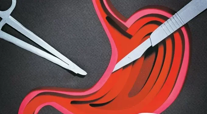 A terapia que devolveu a esperança para curar o câncer de estômago