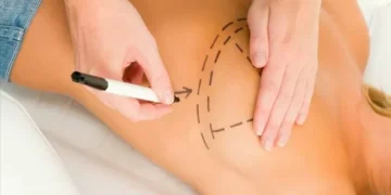 Próteses de silicone: é preciso trocá-las de tempos em tempos?