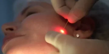 Quem disse que é só a Coreia? Laser da Itália promete acabar com gordura localizada e flacidez, sem cortes