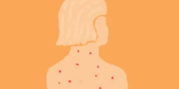 O que levou a região das Américas a perder o certificado de eliminação do sarampo