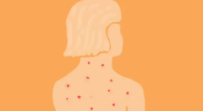 O que levou a região das Américas a perder o certificado de eliminação do sarampo