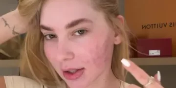 O arrependimento de Virginia após procedimento estético no rosto