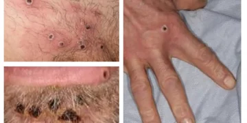 Mpox: como diferenciar as lesões da infecção de outras doenças de pele