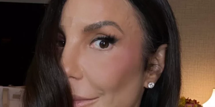 Ivete Sangalo mostra hematomas após acidente: “Só bora”